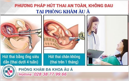 Phương pháp hút thai không đau Phương pháp hút thai không đau