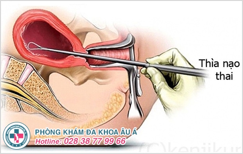 Nạo thai Nạo thai