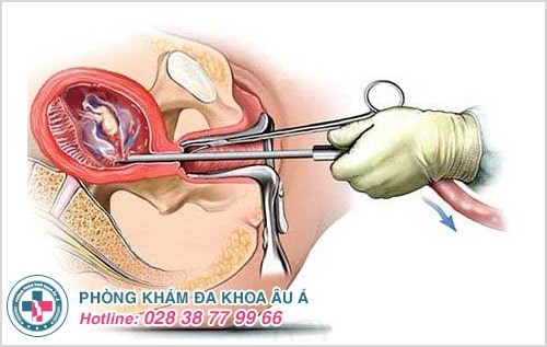 Hút thai an toàn và những điều chị em cần biết Hút thai an toàn và những điều chị em cần biết
