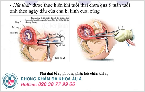 Phương pháp hút thai Phương pháp hút thai