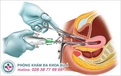 Lành ít dữ nhiều khi nạo hút thai ở phòng khám chui Lành ít dữ nhiều khi nạo hút thai ở phòng khám chui