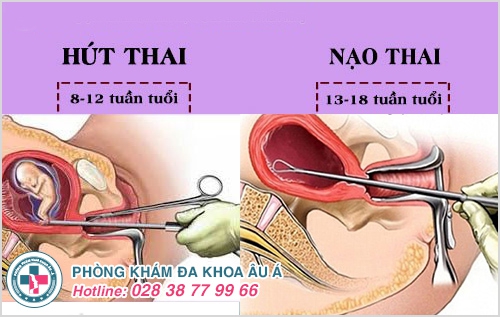 1 số phương pháp nạo thai an toàn Âu Á áp dụng 1 số phương pháp nạo thai an toàn Âu Á áp dụng