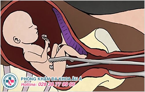 Nong gắp thai có đau không? Nong gắp thai có đau không?