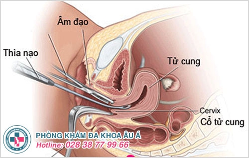 Phá thai 14 tuần có nguy hiểm không? Phá thai 14 tuần có nguy hiểm không?