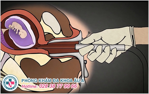 Hình ảnh nạo thai an toàn Hình ảnh nạo thai an toàn