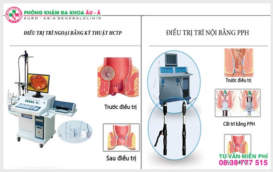 Chi phí phẫu thuật mổ trĩ nội bao nhiêu tiền?