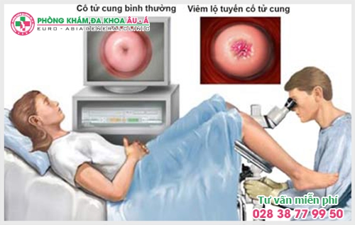 Mối nguy hại của viêm lộ tuyến cổ tử cung