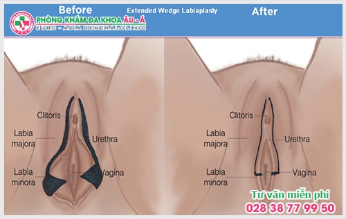 Những lợi ích sau khi thu hẹp âm đạo