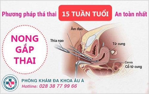 Phá thai 15 tuần có được không? Phá thai 15 tuần có được không?