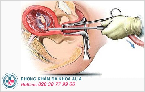 phá thai lớn phá thai lớn