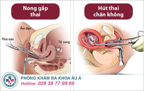 3 phương pháp phá thai không đau hiện nay 3 phương pháp phá thai không đau hiện nay