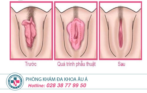 Tại sao cần chỉnh hình môi âm đạo?