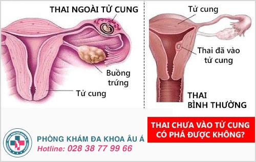 thai chưa vào tử cung có phá được không thai chưa vào tử cung có phá được không